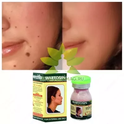 Вартосин от бородавок и папиллом (Wartosin Wart Remover) ORIGINAL Только в розницу
