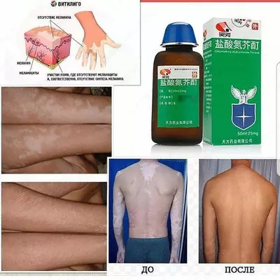 Vitiligo lasenini davolash uchun preparatlar Vitiligo lasenini davolash uchun preparatlar