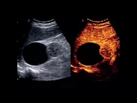 Универсальный ультразвуковой (УЗИ) сканер Esaote MyLab X75 Только в розницу