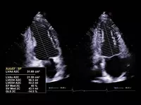 Ультразвуковой сканер премиум класса Esaote MyLab A70 Только в розницу