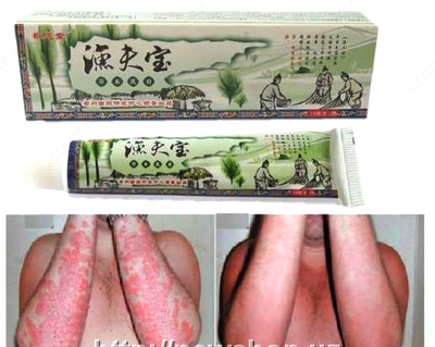 Китайский крем от псориаза "Сокровище рыбака" - 150 000 сум / шт.