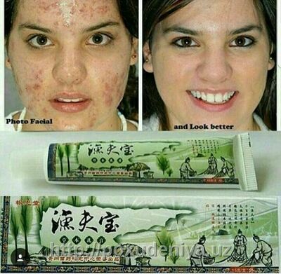 150 000 сум / шт. Китайский крем от псориаза "Сокровище рыбака"