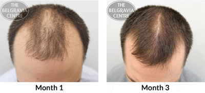 150 000 сум / шт. Миноксидил (minoxidil) Member's Mark для роста бороды и волос