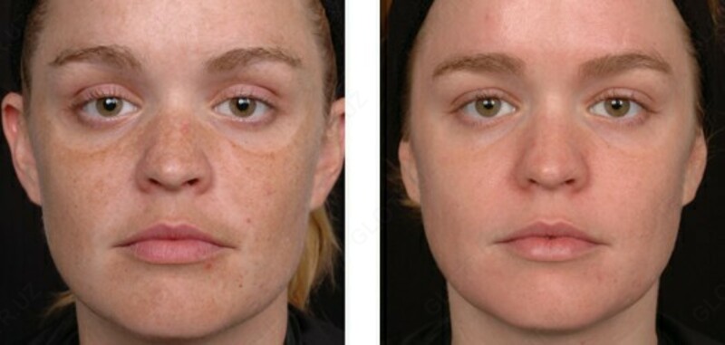 99 000 сум Крем отбеливающий Expigment