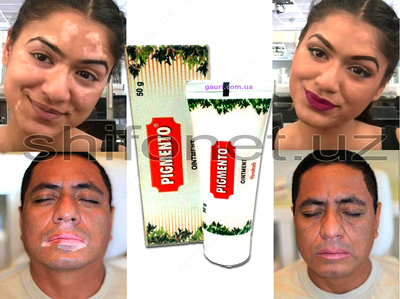 Vitiligo davolash uchun pigmento moyi - Шукуруллаев Шерзод