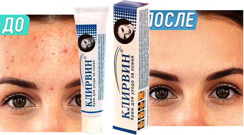 Клирвин (против пятен прыщей и шрамов на коже)