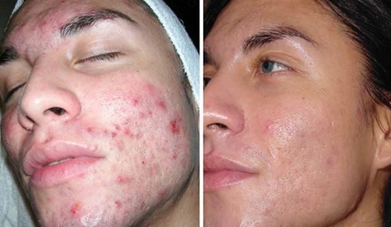 Клирвин (против пятен прыщей и шрамов на коже)