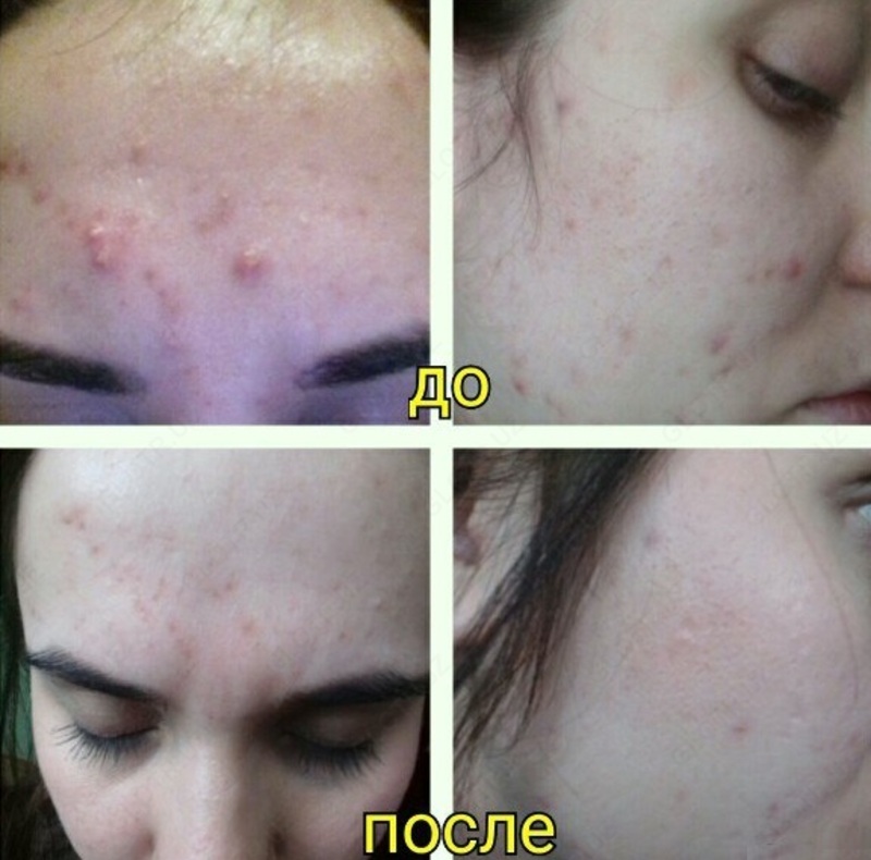 Клирвин (против пятен прыщей и шрамов на коже)