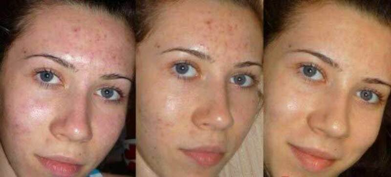 Клирвин (против пятен прыщей и шрамов на коже)