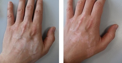 Vitiligoni davolash uchun kompleks - 210 000 so'm / dona