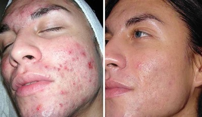 Гель от прыщей Shi fei shi LILSHOP.UZ