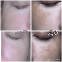 Achroactive max oqartirish kremi (100 ming so'm) Шукуруллаев Шерзод