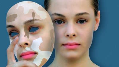 Vitiligo Zanderm Vitiligo Concealer-dan tonna flomaster