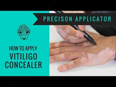 Vitiligo Zanderm Vitiligo Concealer-dan tonna flomaster Vitiligo Zanderm Vitiligo Concealer-dan tonna flomaster