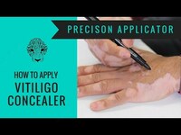 Тональный фломастер от Витилиго Zanderm Vitiligo Concealer - LILSHOP.UZ