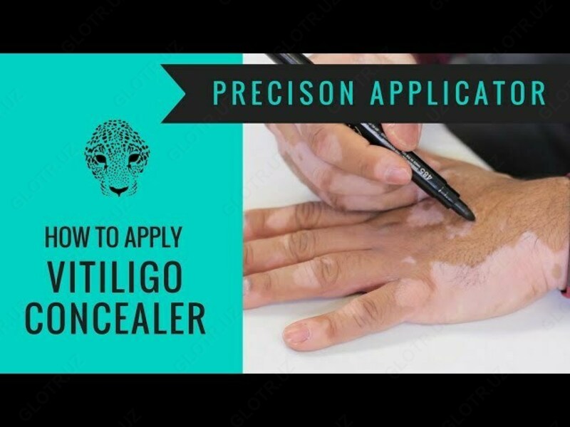 Тональный фломастер от Витилиго Zanderm Vitiligo Concealer