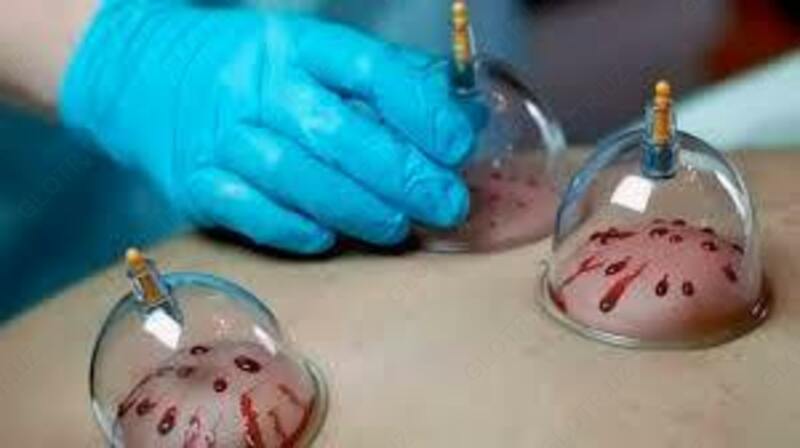 Вакуумные банки для хиджамы - 250 000 сум