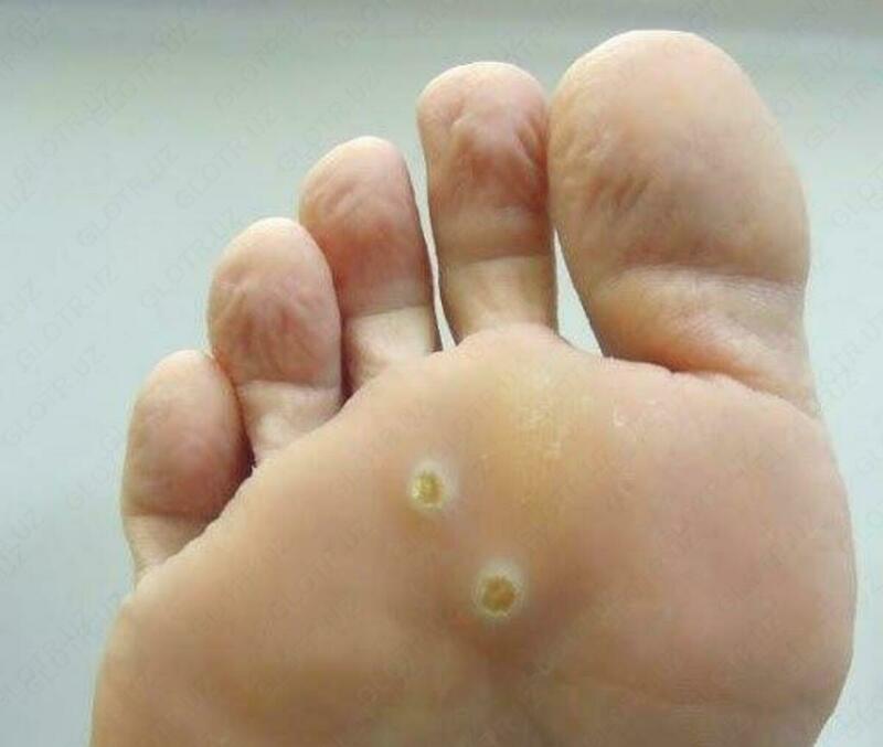 Papillomalarni olib tashlash uchun Verrutol (Verrutol) Chakana savdo