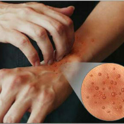 Крем Noura Harraz при аллергии и экземе - 150 000 сум / шт.