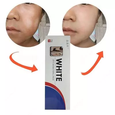 Антибактериальная мазь против витилиго Только в розницу