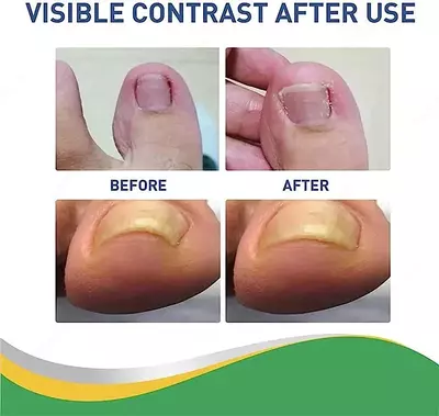 корректор вросших ногтей на ногах