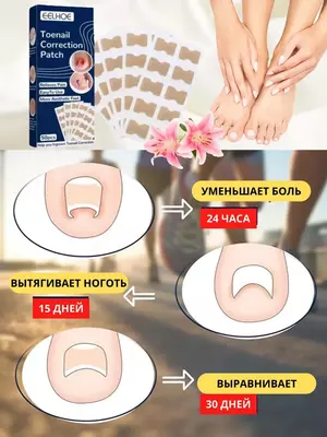 Наклейки для коррекции вросшего ногтя (50 шт). Только в розницу