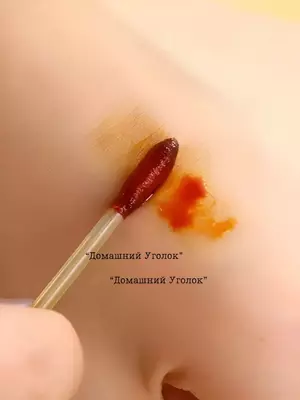 Ватные палочки с йодом и спиртом