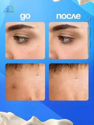 Прозрачные гидроколлоидные фигурные патчи от прыщей (36 шт)