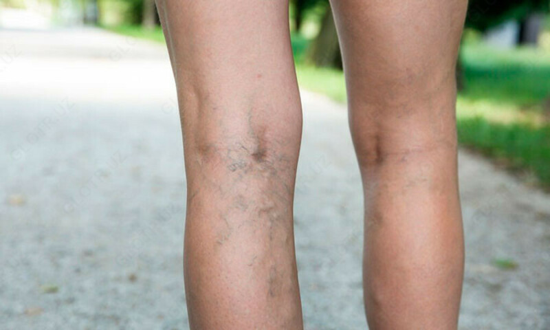  Мазь при варикозе Himalaya Pilex - 