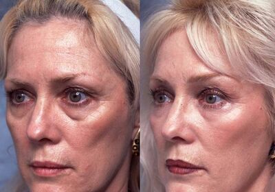 Крем от морщин и пигментных пятен