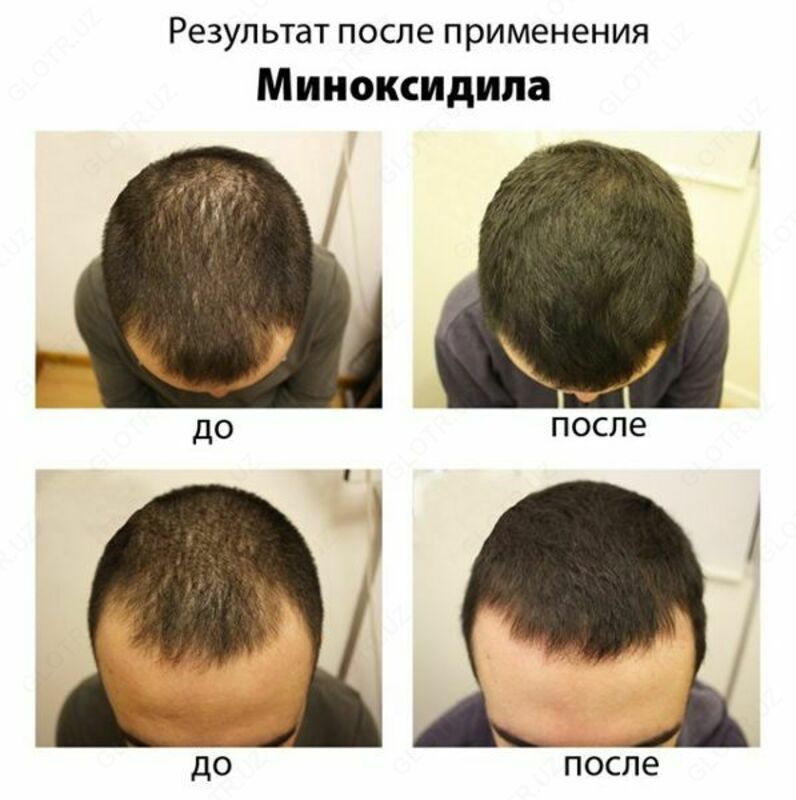 Миноксидил Hair4u 5% (India)