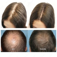 175 000 сум Средство от облысения Minogain 10%