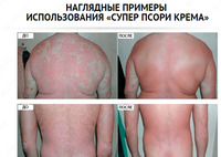 150 000 сум Супер Псори крем