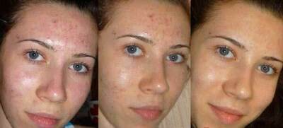 Клирвин (против пятен прыщей и шрамов на коже)