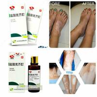Vitiligo uchun xitoy damlamasi Chakana savdo