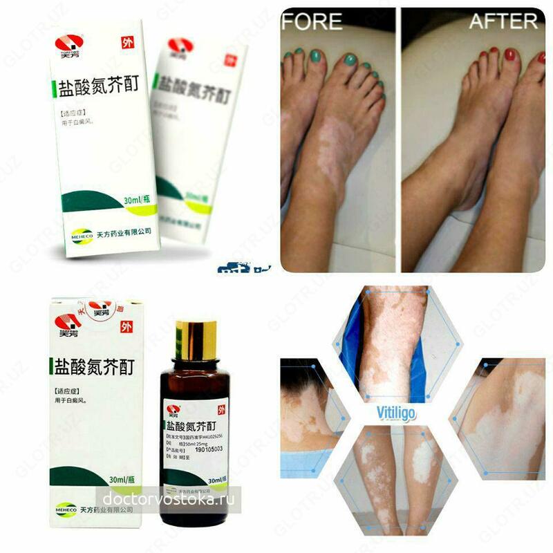 Vitiligo uchun xitoy damlamasi Chakana savdo