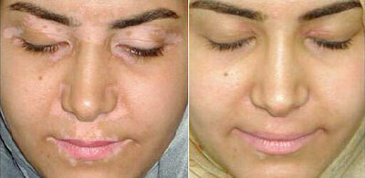 Китайская настойка от витилиго