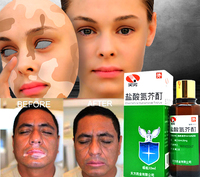 Vitiligo uchun xitoy damlamasi - Dori vositalari