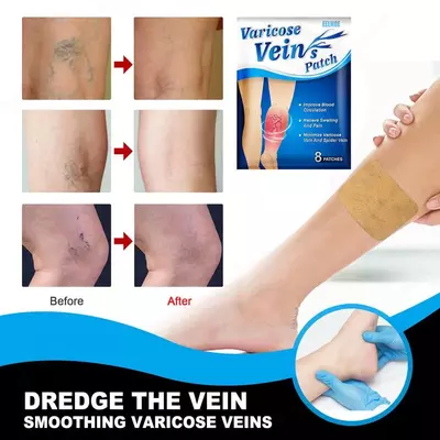 Патчи Sumifun от варикозного расширения вен - 135 000 сум / шт.