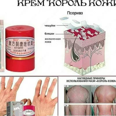 65 000 сум / шт. Тайская мазь Король кожи от псориаза