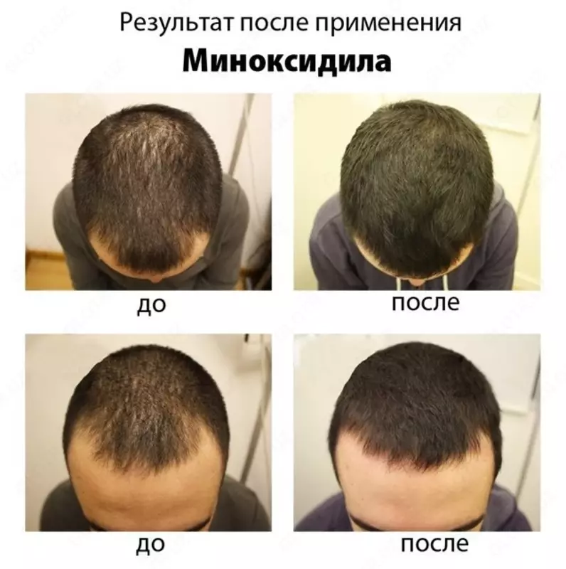165 000 сум Minoxidil 10% лосьон-спрей для роста волос (Таиланд)