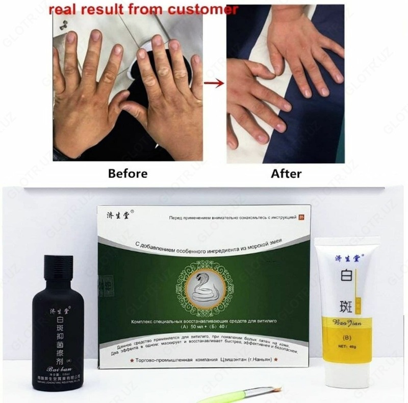 КОМПЛЕКС СПЕЦИАЛЬНЫХ ВОССТАНАВЛИВАЮЩИХ СРЕДСТВ ДЛЯ ВИТИЛИГО (НАБОР ЗМЕЯ) ВЫРАБАТЫВАЕТ МЕЛАНИН (КОЖНЫЙ ПИГМЕНТ)