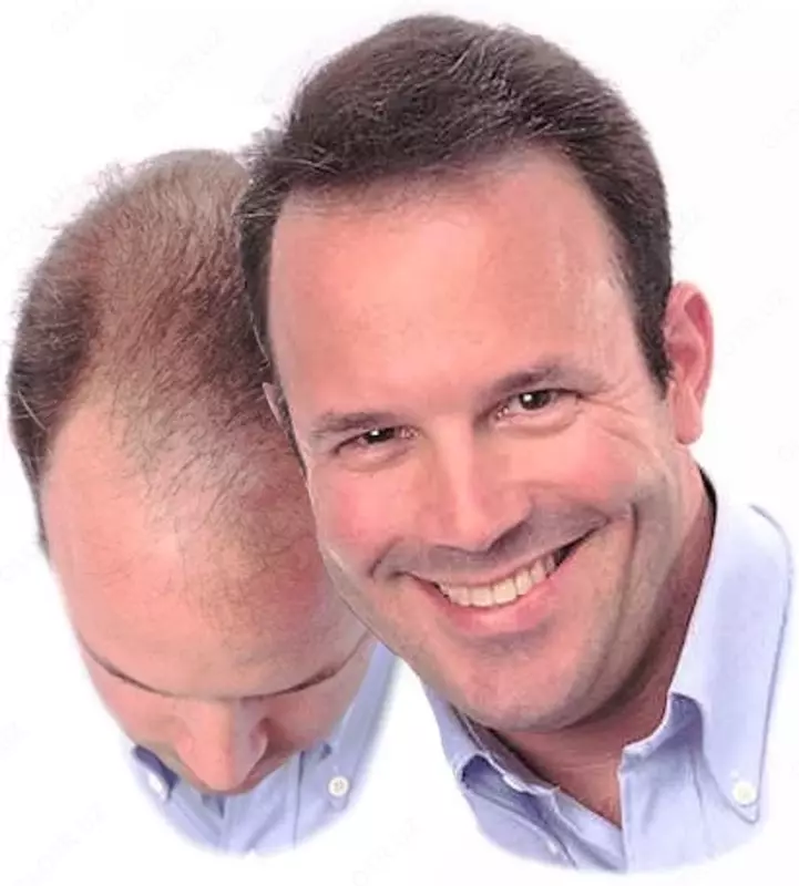   Миноксидил 15% iiSolutions Minoxidil 15% + Azelaic Acid 5%