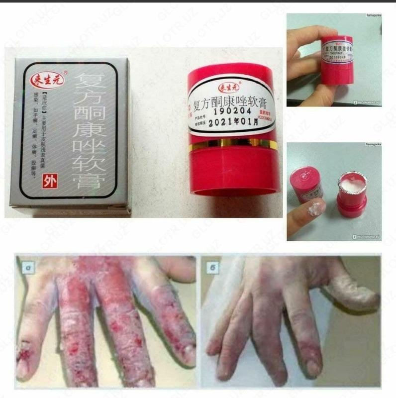 Toshbaqa kasalligi uchun xitoy malhami Teri qiroli