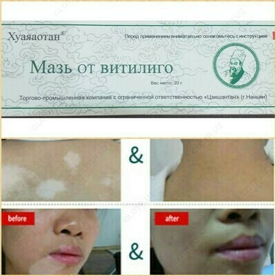 Vitiligo Huayaotan uchun malham
