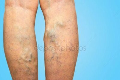 Varikoz tomirlari uchun malham Himoloy Pilex Chakana savdo