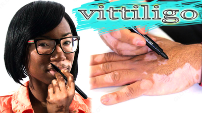 Vitiligo Zanderm Vitiligo Concealer asosli marker