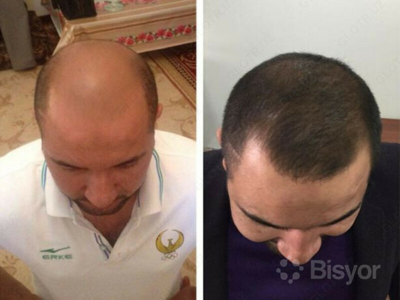 200 000 so'mdan Nuzen oltin soch yog'i