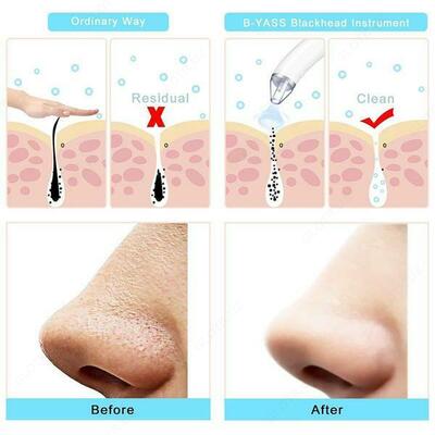 Вакуумный очиститель пор лица Comedo Suction