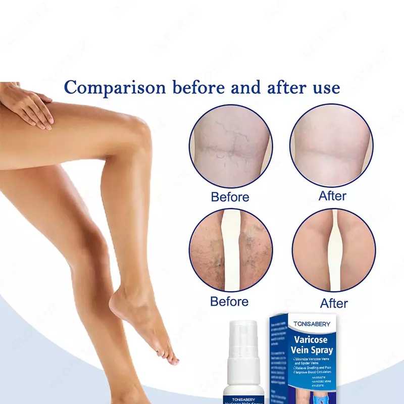 Varicose vein Spray Спрей от варикоза вен